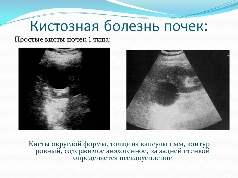 Кистозная болезнь почек: Простые кисты почек 1 типа:      